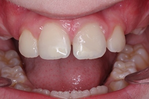 τελική εικόνα μετά την συγκόλληση κατεαγότος τμήματος δοντιού και αποκατάσταση με σύνθετη ρητίνη